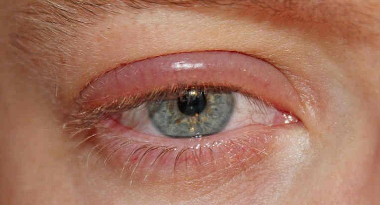 Demodicosis on the eyelids